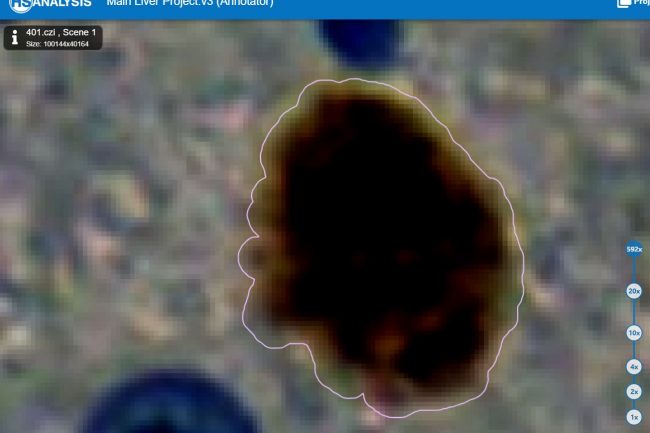 Fig. 6: Cells positive (Brown, marked pink) of liver model with low opacity