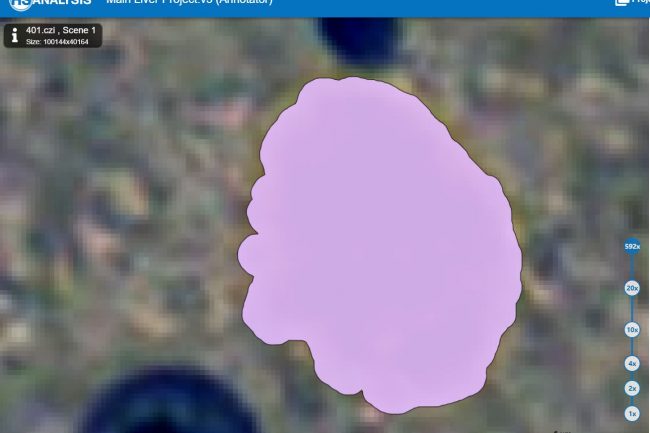 Fig. 7: Cells positive (Brown, marked pink) of liver model with high opacity