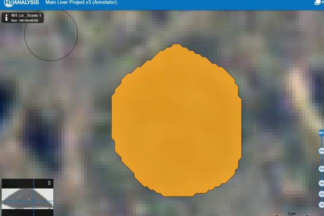 Fig. 9: Uncertain Cells (Between cell positive and cell negative, marked orange) of liver model with high opacity