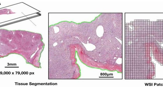 Fig. 4: Whole Slide Image (WSI) Divided into Patches for Model Training