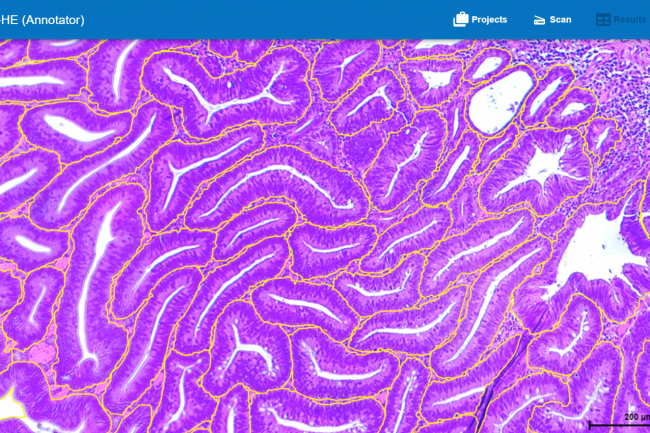 Abb. 2: Im HSA KIT detektiertes Adenom (Gelb umrandet)