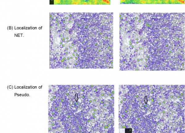Comparison of the HSA KIT’s heatmap tool for different ((A) erythrocyte and leukocytes, (B) NET, (C) Pseudo-Gaucher-Zelle and (D) Megakaryozyt) (type 1 & 2) models