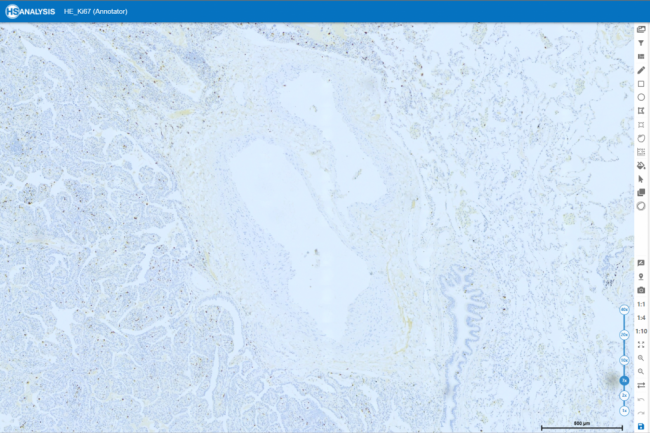 Example Ki67 immunohistochemistry-stained images of colorectal cancer 