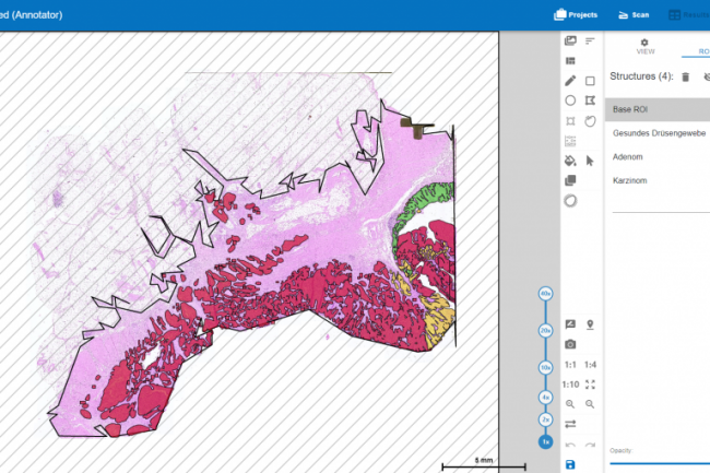 Figure shows all kinds of tissue, green = healthy tissue, yellow = adenoma, red = carcinoma