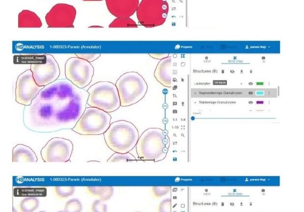Light-Blue = Neutrophile Segmentkerniger Granulocyte / Red = Erythrocytes