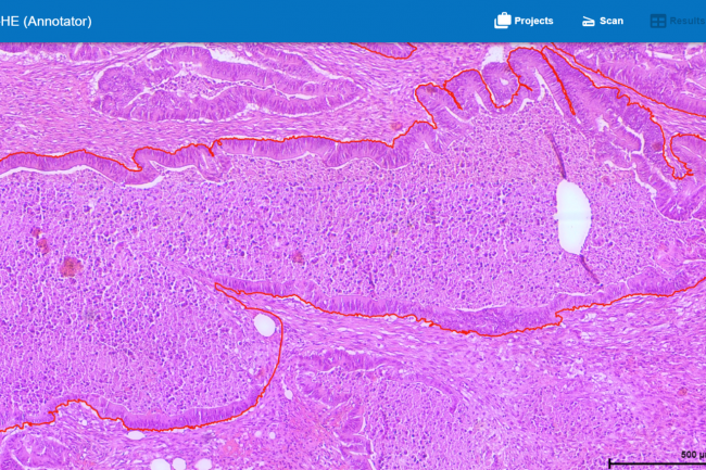 Abb. 3: Im HSA KIT detektiertes Karzinom (rot umrandet)