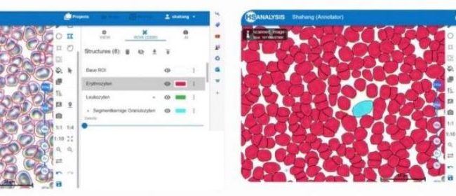 Left: Multiple Cells / Right: Multiple Cell Detection with HyperHaemaNet Model
