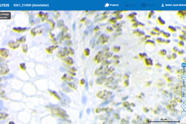Here is an example of the cells at the beginning before we select tumor cells