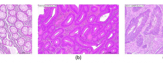 (a) Healthy tissue, (b) Adenoma, (c) Carcinoma