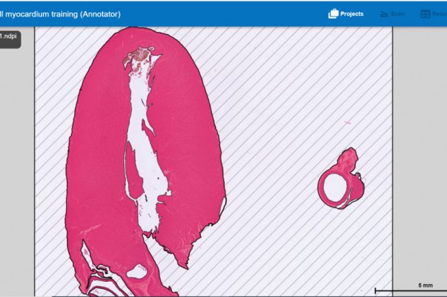 Fig. 16: Myocardium Bar is 5mm