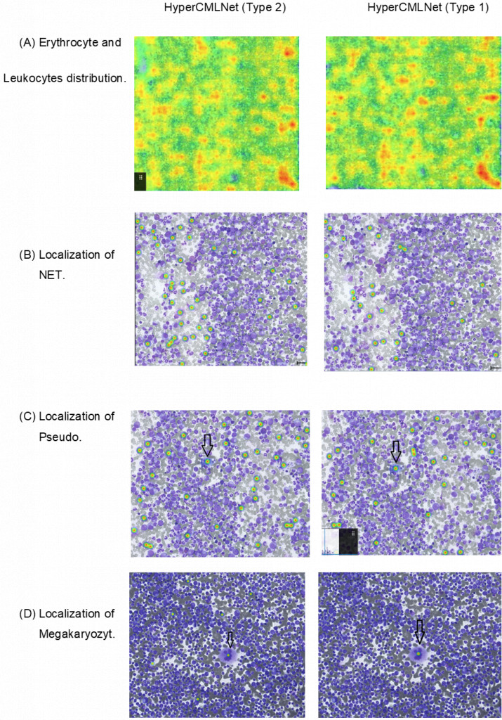 Comparison of the HSA KIT’s heatmap tool for different ((A) erythrocyte and leukocytes, (B) NET, (C) Pseudo-Gaucher-Zelle and (D) Megakaryozyt) (type 1 & 2)  models