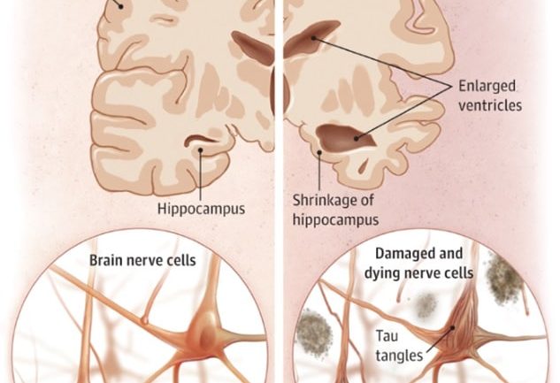 The difference between healthy brain and Alzheimer’s disease brain in physiological structure and neurons.